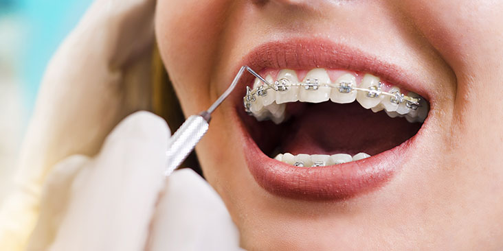 Orthodontic Treatment Offered for Everyone – Dentist Milton, ON